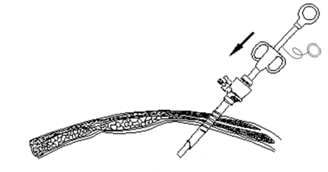 一次性使用内窥镜用活检袋注册审查 - 活检袋进入体内示意图