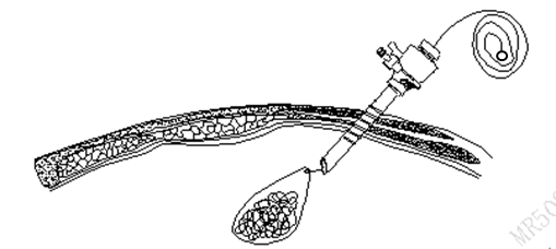 一次性使用内窥镜用活检袋注册审查 - 收紧拉绳示意图