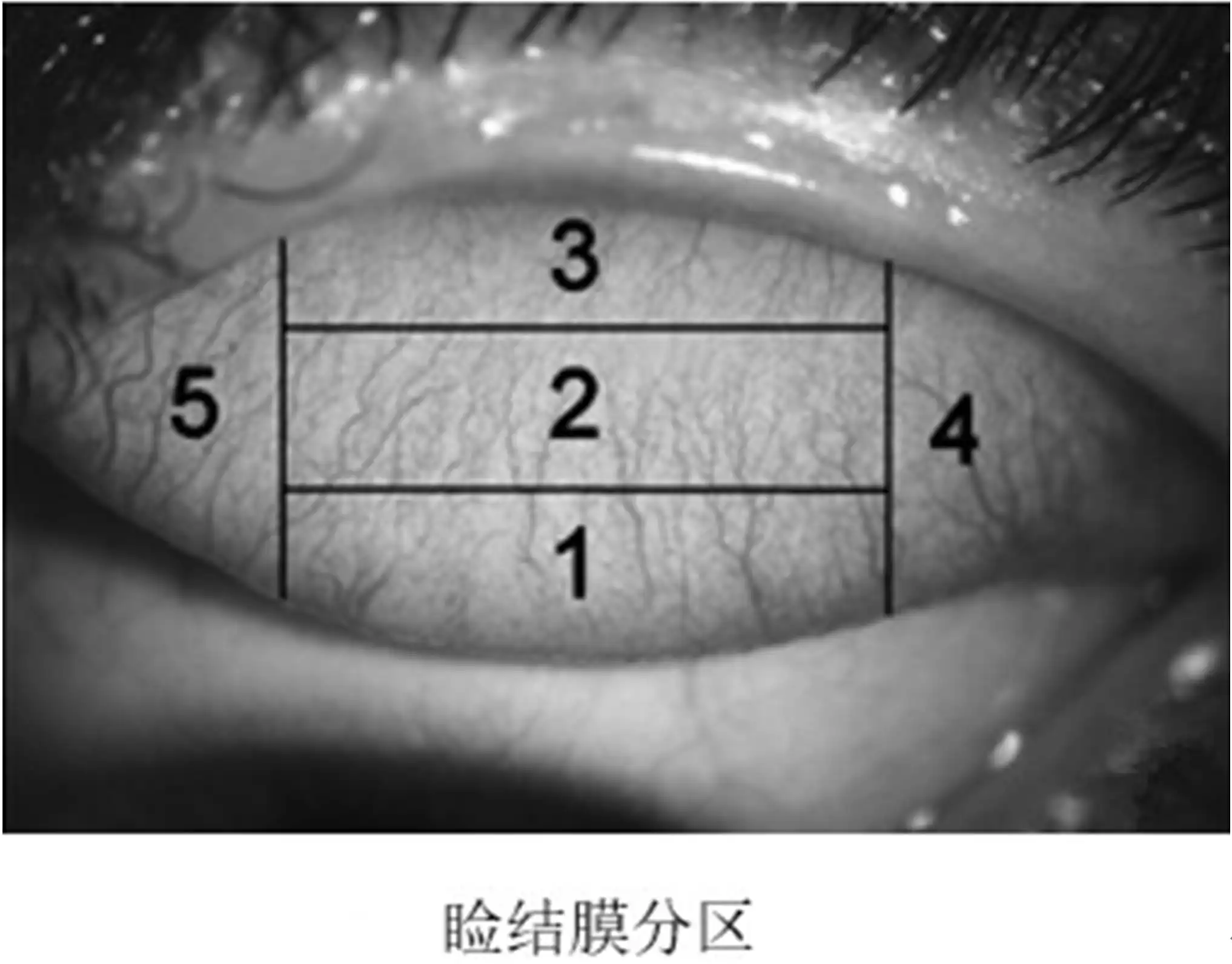 软性接触镜临床评价 - 睑结膜区域划分图