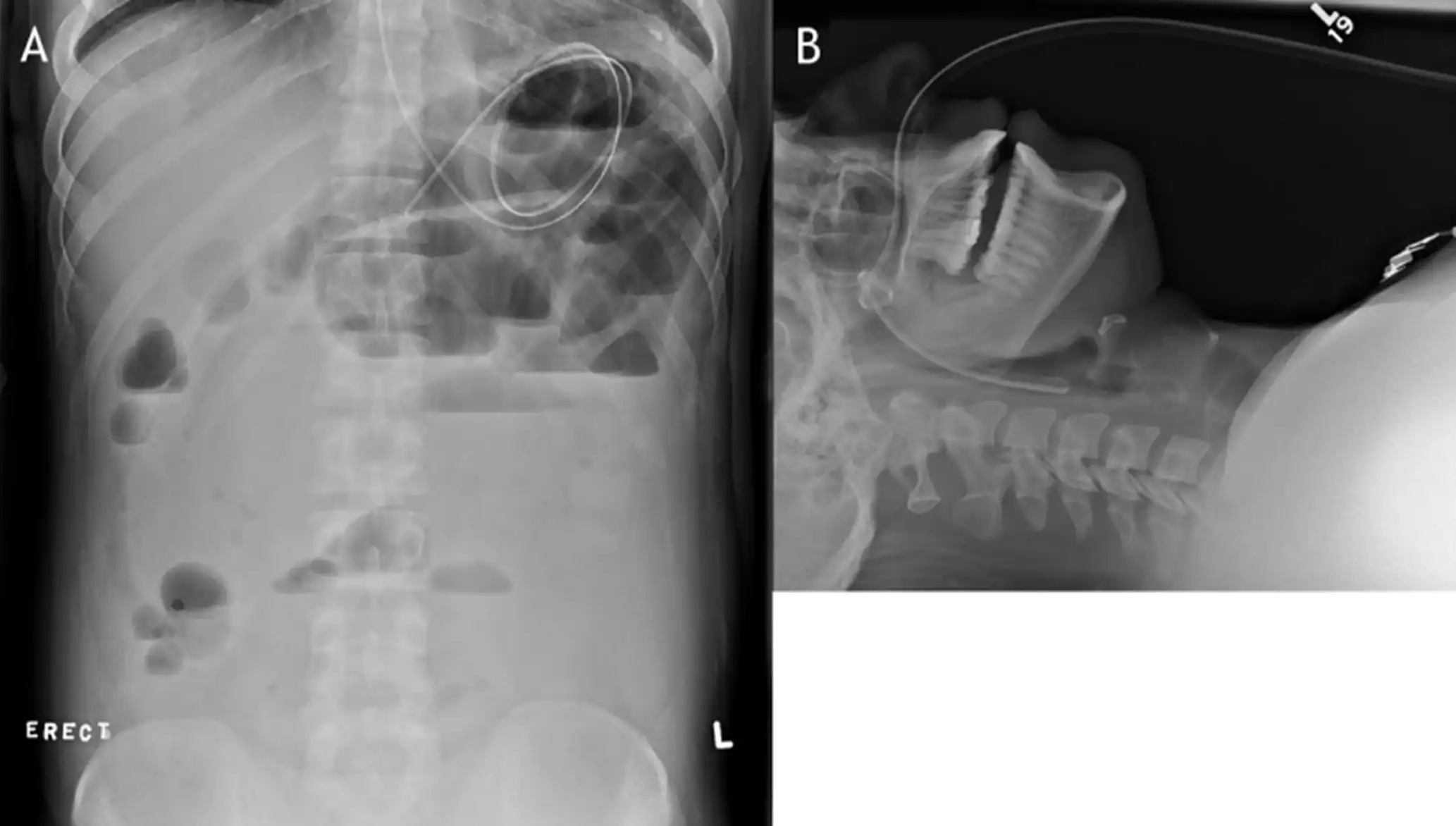 经鼻肠营养导管注册审查 - 打结X光照片