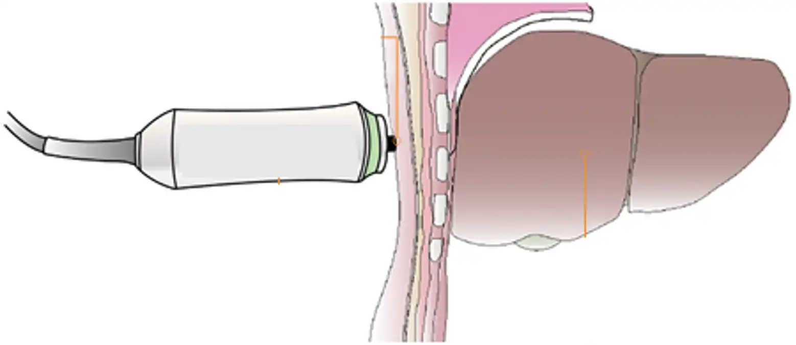 定量剪切波超声肝脏测量仪注册审查测量原理图解