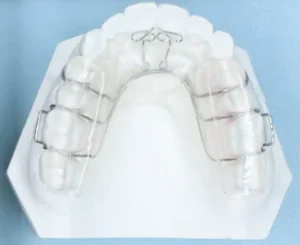 定制式正畸矫治器注册审查中的舌簧颌垫矫治器示例