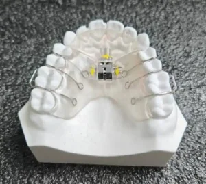 定制式正畸矫治器注册审查中的三向基托螺旋扩弓器示例