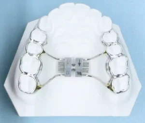 定制式正畸矫治器注册审查中的快速扩弓器示例