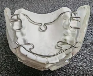 定制式正畸矫治器注册审查中的FR-Ⅲ型功能矫治器示例