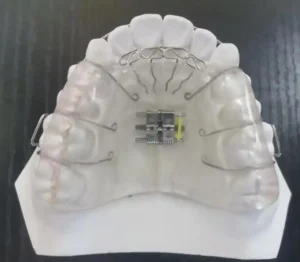 定制式正畸矫治器注册审查中的螺旋可调矫治器示例